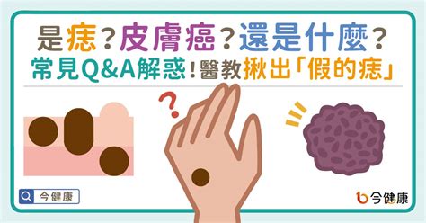 身體有痣|是痣？皮膚癌？還是什麼？常見Q&A解惑！醫教揪出「。